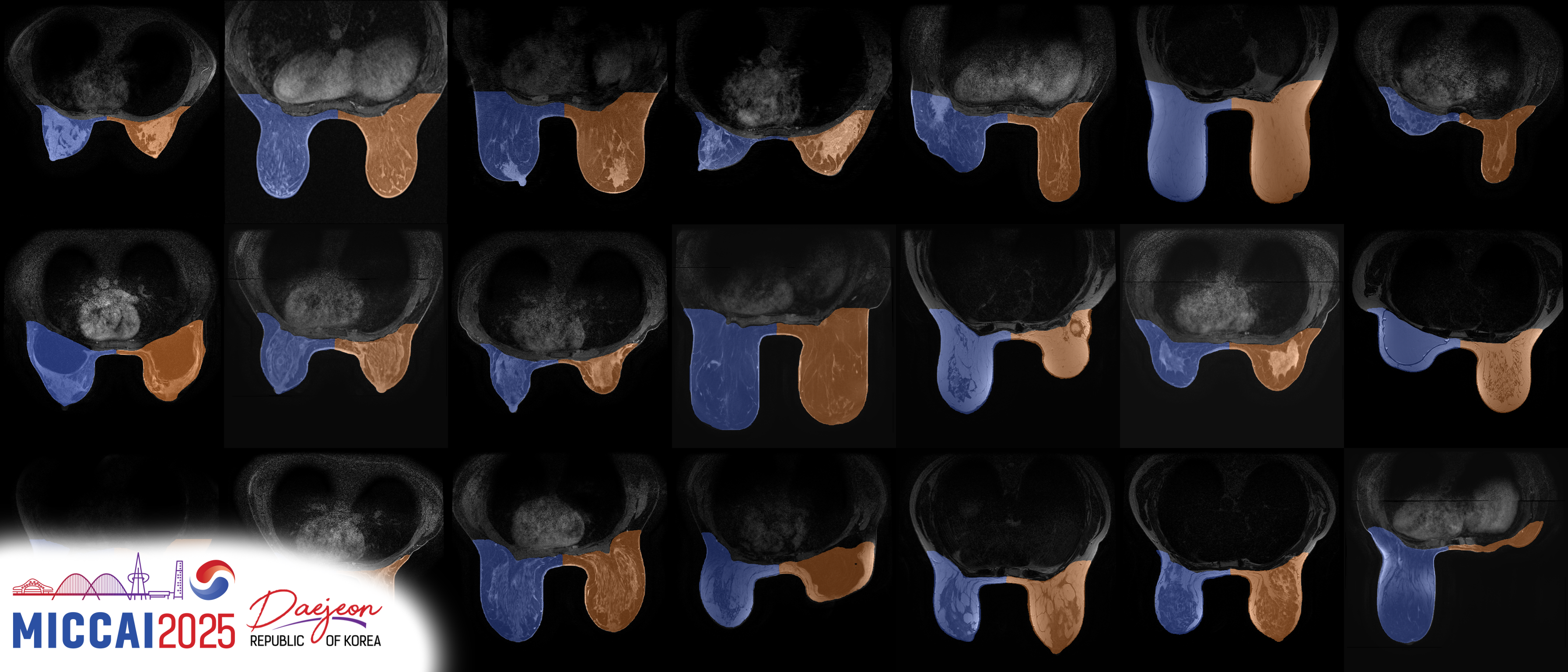 BreastDivider Overview